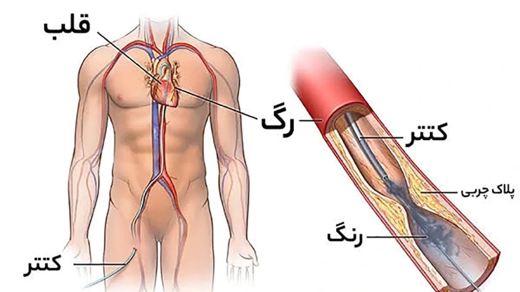 فوق تخصص آنژیوگرافی قلب در غرب تهران تشریح نحوه انجام آنژیوگرافی از کشاله ران قابل مشاهده است.