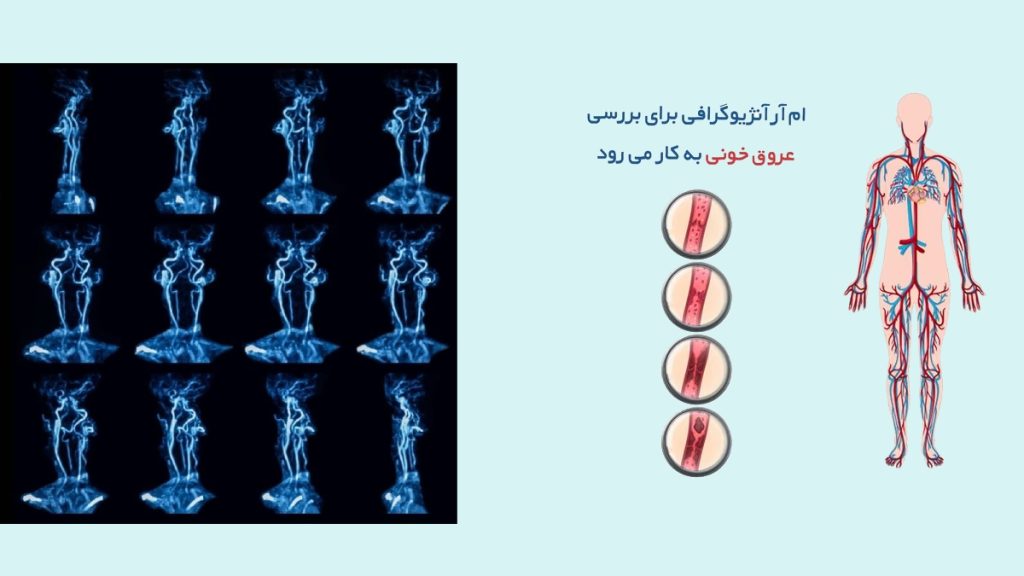 دلیل انجام ام آر آنژیوگرافی چیست؟