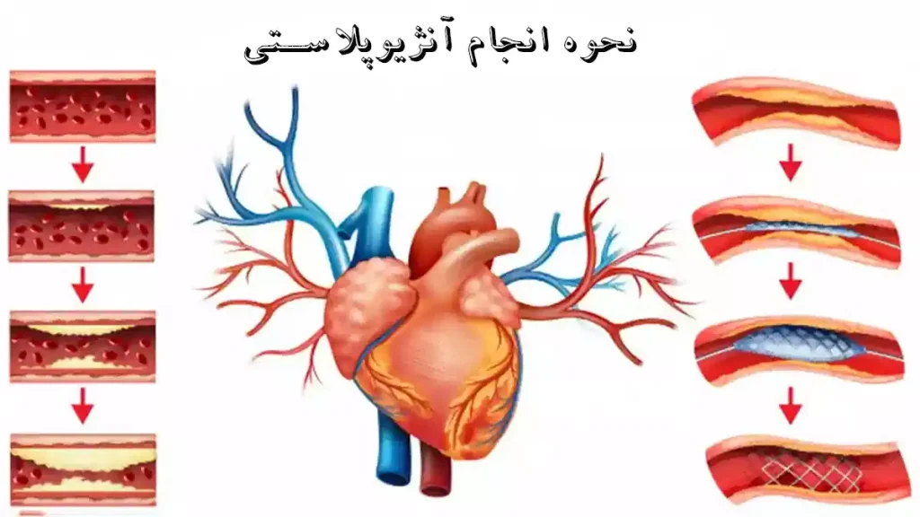 نحوه انجام آنژیوپلاستی نحوه انجام آنژیوپلاستی به وسیله فوق تخصص آنژیوپلاستی و استنت