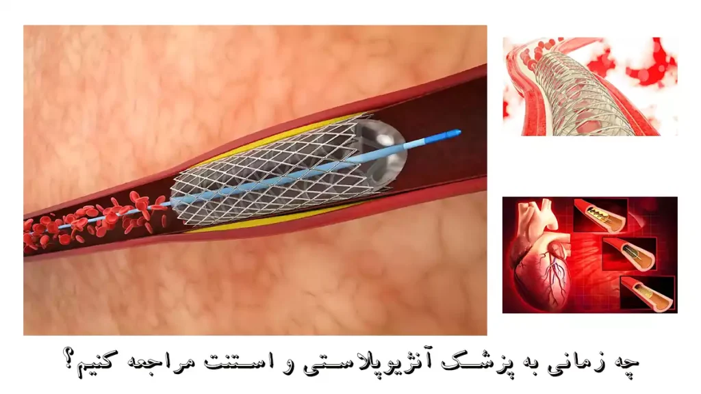 چه زمانی به پزشک آنژیوپلاستی و استنت مراجعه کنیم؟ چه زمانی به پزشک آنژیوپلاستی و استنت مراجعه کنیم؟